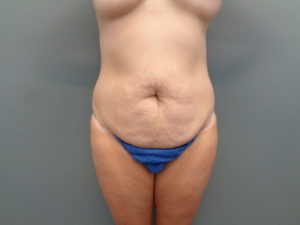 Tummy Tuck Before & After Pictures in Nashville, TN