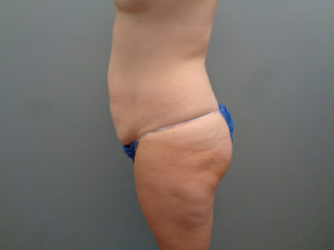 Tummy Tuck Before & After Pictures in Nashville, TN