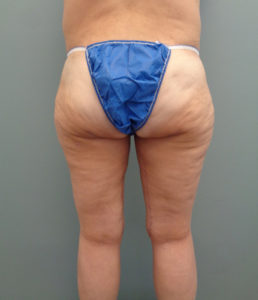 Thigh Lift Before & After Pictures in Nashville, TN