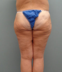Thigh Lift Before & After Pictures in Nashville, TN