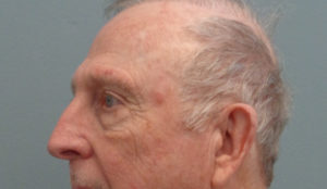Blepharoplasty Before & After Pictures in Nashville, TN