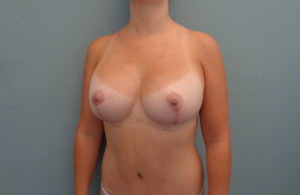 Breast Augmentation with Lift Before & After Pictures in Nashville, TN