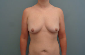 Breast Augmentation with Lift Before & After Pictures in Nashville, TN