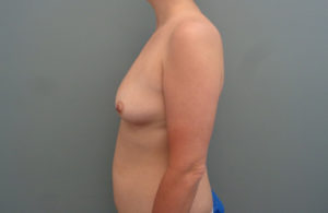 Breast Augmentation with Lift Before & After Pictures in Nashville, TN