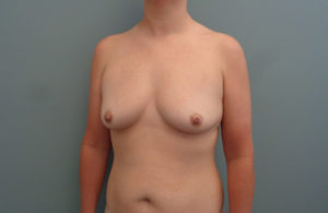 Breast Augmentation with Lift Before & After Pictures in Nashville, TN