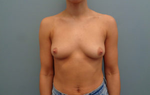 Breast Augmentation Before & After Pictures in Nashville, TN