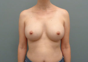 Breast Augmentation Before & After Pictures in Nashville, TN