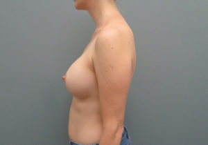 Breast Augmentation Before & After Pictures in Nashville, TN