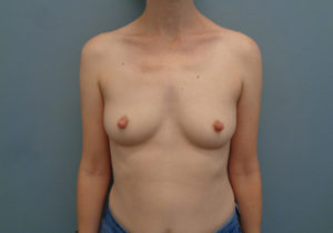 Breast Augmentation Before & After Pictures in Nashville, TN