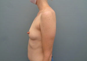 Breast Augmentation Before & After Pictures in Nashville, TN