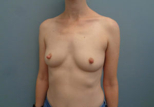 Breast Augmentation Before & After Pictures in Nashville, TN