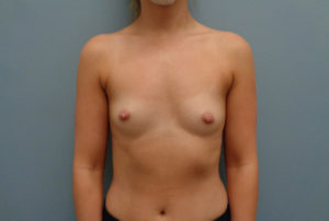 Breast Augmentation Before & After Pictures in Nashville, TN