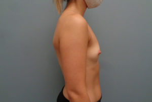 Breast Augmentation Before & After Pictures in Nashville, TN