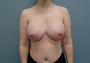 Breast Augmentation Before & After Pictures in Nashville, TN