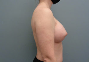 Breast Augmentation Before & After Pictures in Nashville, TN