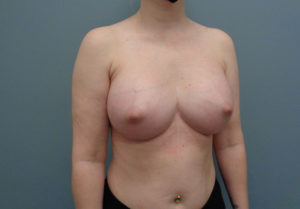 Before & After Pictures in Nashville, TN