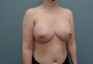 Breast Augmentation Before & After Pictures in Nashville, TN