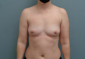 Breast Augmentation Before & After Pictures in Nashville, TN