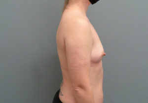 Breast Augmentation Before & After Pictures in Nashville, TN