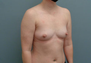 Breast Augmentation Before & After Pictures in Nashville, TN