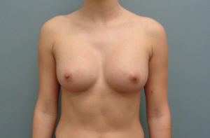 Breast Augmentation Before & After Pictures in Nashville, TN