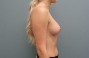 Breast Augmentation Before & After Pictures in Nashville, TN