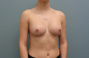 Breast Augmentation Before & After Pictures in Nashville, TN