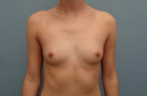 Breast Augmentation Before & After Pictures in Nashville, TN