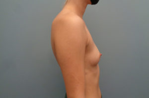 Breast Augmentation Before & After Pictures in Nashville, TN