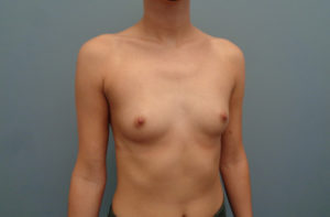 Breast Augmentation Before & After Pictures in Nashville, TN