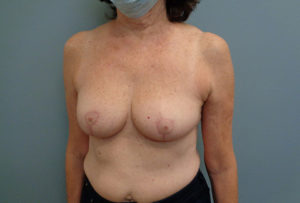 Breast Reduction Before & After Pictures in Nashville, TN