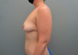 Breast augmentation with Lift Before & After Pictures in Nashville, TN