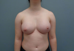 Breast Augmentation Before & After Pictures in Nashville, TN