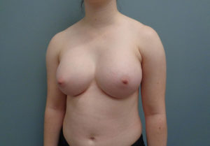 Breast Augmentation Before & After Pictures in Nashville, TN