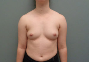 Breast Augmentation Before & After Pictures in Nashville, TN