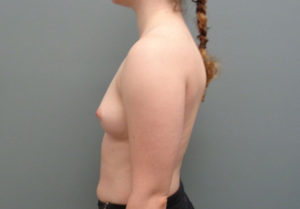 Breast Augmentation Before & After Pictures in Nashville, TN