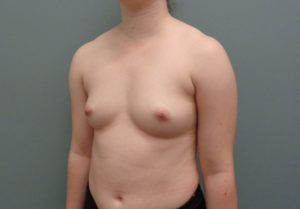 Breast Augmentation Before & After Pictures in Nashville, TN