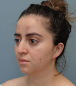 Rhinoplasty Before & After Pictures in Nashville, TN