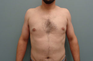 Gynecomastia Before & After Pictures in Nashville, TN