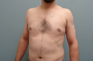 Gynecomastia Before & After Pictures in Nashville, TN