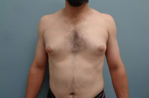 Gynecomastia Before & After Pictures in Nashville, TN