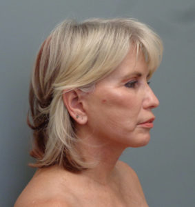 Facelift Before & After Pictures in Nashville, TN