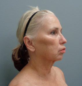 Facelift Before & After Pictures in Nashville, TN