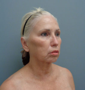 Facelift Before & After Pictures in Nashville, TN