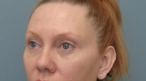 Blepharoplasty Before & After Pictures in Nashville, TN