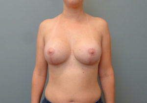 Breast Augmentation with Lift Before & After Pictures in Nashville, TN