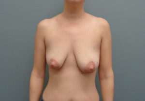 Breast Augmentation with Lift Before & After Pictures in Nashville, TN