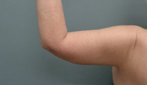 Arm Lift Before & After Pictures in Nashville, TN