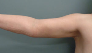 Arm Lift Before & After Pictures in Nashville, TN
