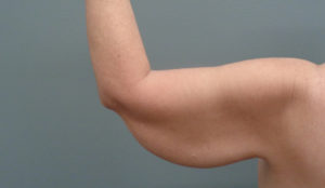 Arm Lift Before & After Pictures in Nashville, TN